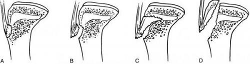 Растяжение связок колена сроки восстановления. Характер разрыва и степени
