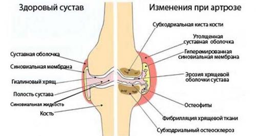 Опухли косточки на пальцах рук причины лечение. Основные причины и методы лечения опухших суставов пальцев на руке