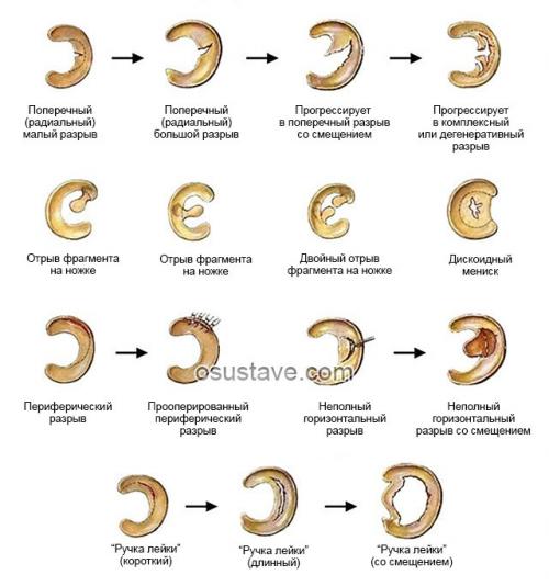 Повреждение переднего рога медиального мениска. Виды повреждений, три степени по Столлеру
