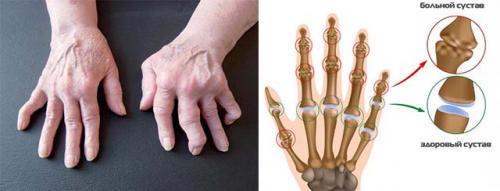 Опухли косточки на пальцах рук причины лечение. Основные причины и методы лечения опухших суставов пальцев на руке