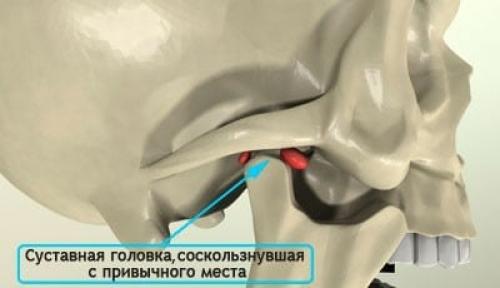 Височно нижнечелюстной сустав лечение. Основные причины появления боли в височно-нижнечелюстном суставе