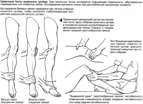 Растяжение связок колена сроки восстановления. Характер разрыва и степени