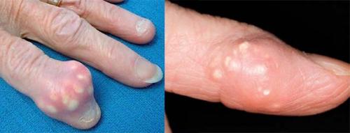 Опухли косточки на пальцах рук причины лечение. Основные причины и методы лечения опухших суставов пальцев на руке