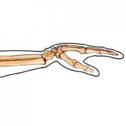 Сколько срастаются лучевые кости на руке