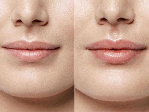 Нельзя после инъекции гиалуроновой кислоты. Особенности ухода 01 Нельзя после инъекции гиалуроновой кислоты. Особенности ухода 01