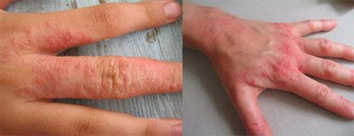 Опухли косточки на пальцах рук причины лечение. Основные причины и методы лечения опухших суставов пальцев на руке