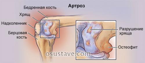 Внезапная боль в колене. Болезни
