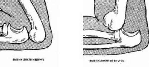 Травмы локтевого сустава. Повреждение локтевого сустава