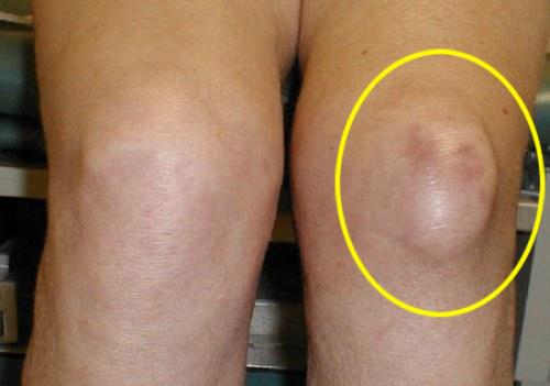 Внезапная боль в колене. Болезни