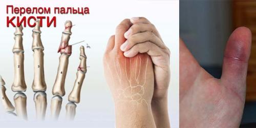 Опухли суставы пальцев рук лечение. Основные причины и методы лечения опухших суставов пальцев на руке