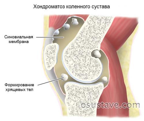 Внезапная боль в колене. Боль в колене. Реабилитация после травм и заболеваний коленных суставов. Боль в колене - Центр доктора Бубновского Мазь от боли в коленях: обзор эффективных средств