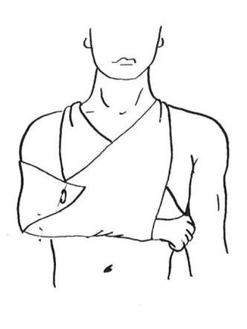 Повязка варежка на кисть. Алгоритм наложения повязки «варежка» на все пальцы кисти.