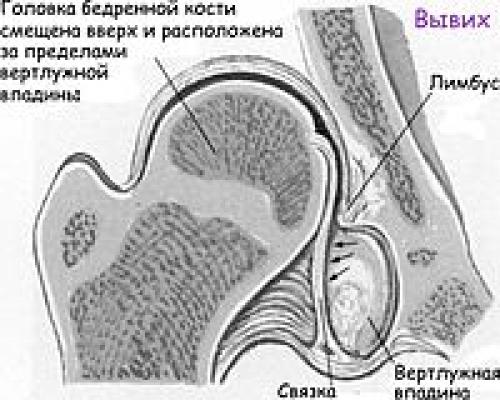 Углы тбс норма таблица. Анатомические особенности тазобедренного сустава при дисплазии 02 Углы тбс норма таблица. Анатомические особенности тазобедренного сустава при дисплазии 02