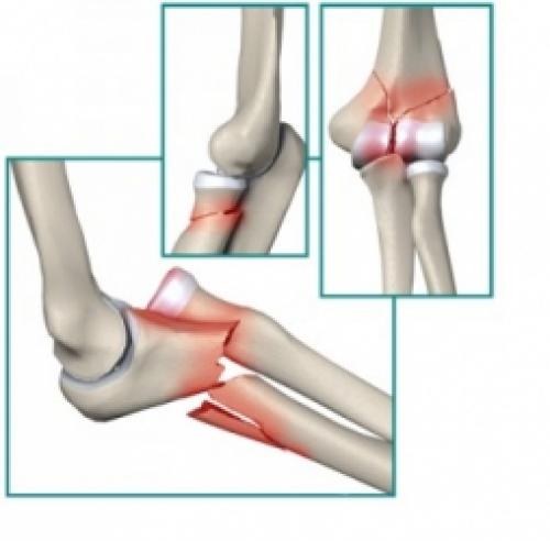 Травмы локтевого сустава при падении. Обзор ушиба локтевого сустава: виды, степени, симптомы и лечение 05 Травмы локтевого сустава при падении. Обзор ушиба локтевого сустава: виды, степени, симптомы и лечение 05