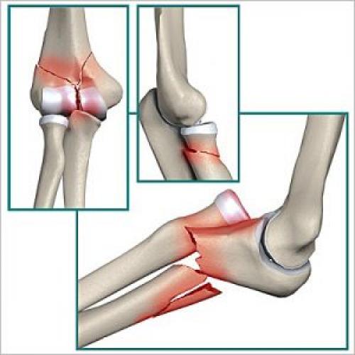 Травмы локтевого сустава. Повреждение локтевого сустава