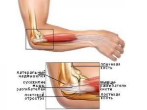 Травмы локтевого сустава. Повреждение локтевого сустава
