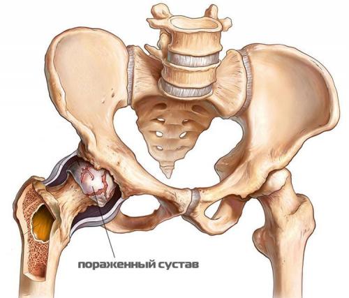 Зажатые тазобедренные суставы. Чем опасно разрушение тазобедренного сустава: признаки и симптомы, тактика лечения
