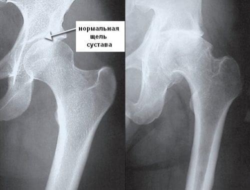 Зажатые тазобедренные суставы. Чем опасно разрушение тазобедренного сустава: признаки и симптомы, тактика лечения