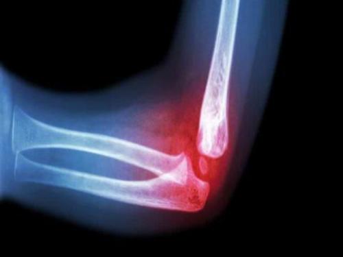 Травмы локтевого сустава у детей. Перелом локтевого сустава у ребенка