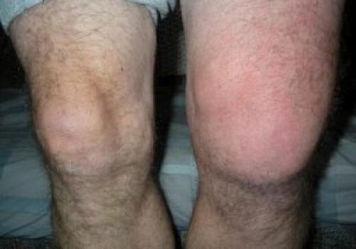 Защемление нерва коленного. Защемление нерва в коленном суставе лечение, симптомы