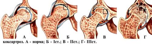 Зажатые тазобедренные суставы. Чем опасно разрушение тазобедренного сустава: признаки и симптомы, тактика лечения