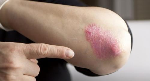 Покраснение локтя. Все про красные пятна на локтях