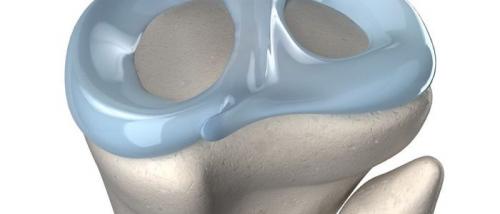 Безоперационное лечение мениска. Как лечить мениск в домашних условиях?