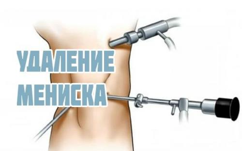 Как разрабатывать колено после операции на мениск. Показания к оперативному лечению