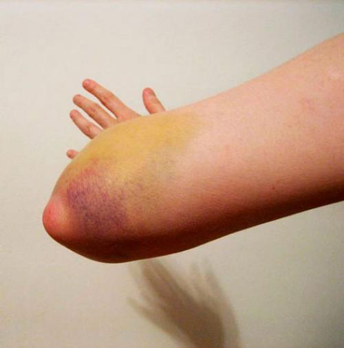 Ушиб левого локтевого сустава. Обзор ушиба локтевого сустава: виды, степени, симптомы и лечение