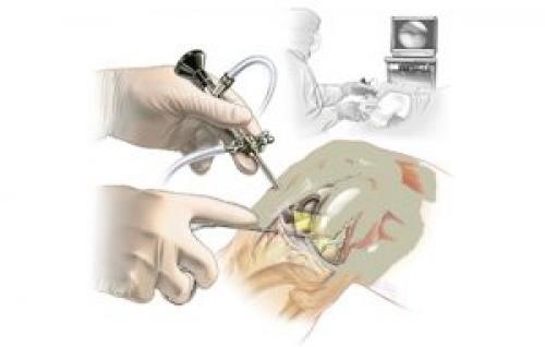 Синовит у ребенка. Детский синовит