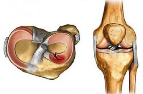 Порван мениск коленного сустава последствия. Симптомы повреждения мениска 07