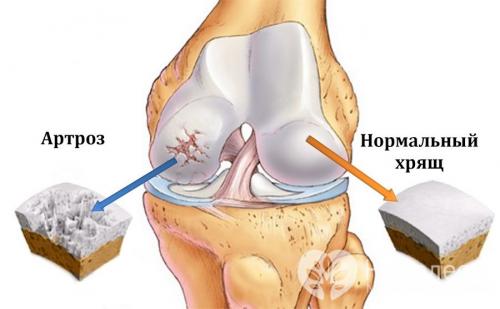 Артроз коленного сустава