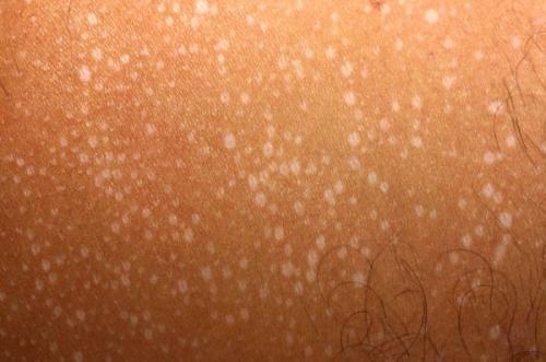 Как избавиться от пигментных пятен на лице. Пигментное пятно —, что это такое 19 Как избавиться от пигментных пятен на лице. Пигментное пятно —, что это такое 19