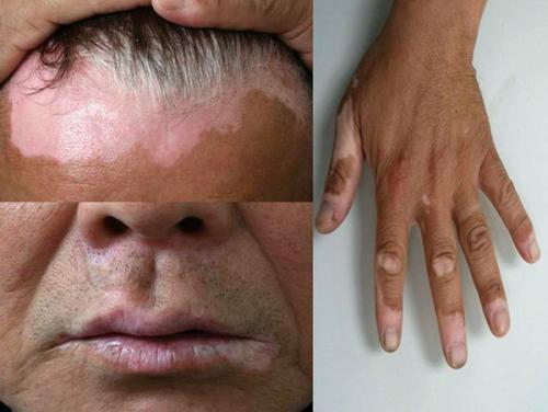 Как избавиться от пигментных пятен на лице. Пигментное пятно —, что это такое 13 Как избавиться от пигментных пятен на лице. Пигментное пятно —, что это такое 13