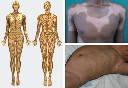 Как избавиться от пигментных пятен на лице. Пигментное пятно —, что это такое 17 Как избавиться от пигментных пятен на лице. Пигментное пятно —, что это такое 17