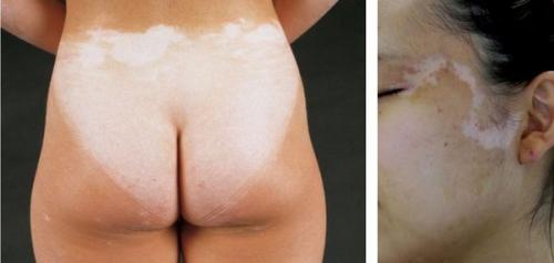 Как избавиться от пигментных пятен на лице. Пигментное пятно —, что это такое 16 Как избавиться от пигментных пятен на лице. Пигментное пятно —, что это такое 16