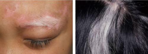 Как избавиться от пигментных пятен на лице. Пигментное пятно —, что это такое 10 Как избавиться от пигментных пятен на лице. Пигментное пятно —, что это такое 10