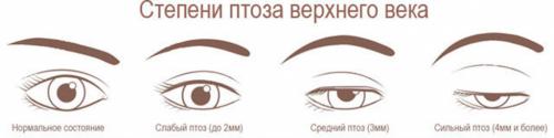 Как избавиться от птоза верхних век на лице. Причины развития патологического опущения верхнего века 01