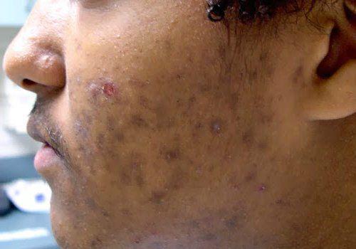 Как избавиться от пигментных пятен на лице. Пигментное пятно —, что это такое 04 Как избавиться от пигментных пятен на лице. Пигментное пятно —, что это такое 04