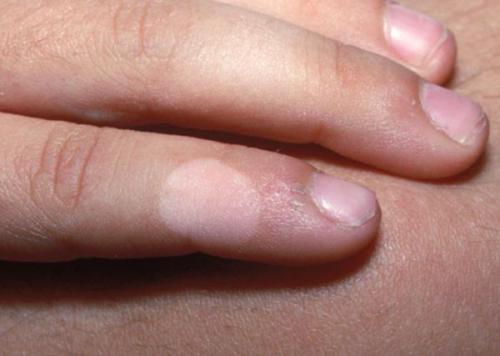 Как избавиться от пигментных пятен на лице. Пигментное пятно —, что это такое 15 Как избавиться от пигментных пятен на лице. Пигментное пятно —, что это такое 15