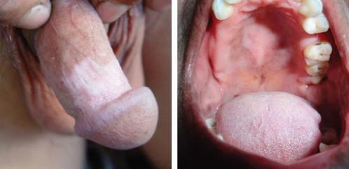 Как избавиться от пигментных пятен на лице. Пигментное пятно —, что это такое 18 Как избавиться от пигментных пятен на лице. Пигментное пятно —, что это такое 18