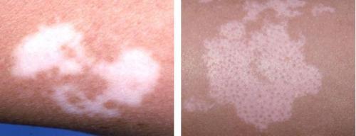 Как избавиться от пигментных пятен на лице. Пигментное пятно —, что это такое 09 Как избавиться от пигментных пятен на лице. Пигментное пятно —, что это такое 09