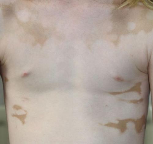 Как избавиться от пигментных пятен на лице. Пигментное пятно —, что это такое 14 Как избавиться от пигментных пятен на лице. Пигментное пятно —, что это такое 14