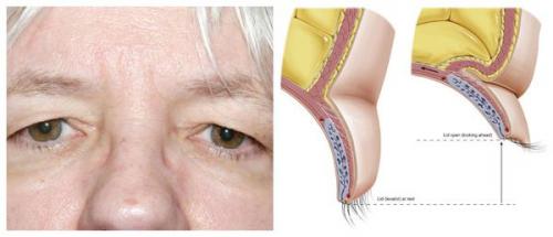 Как избавиться от птоза верхних век на лице. Причины развития патологического опущения верхнего века 05