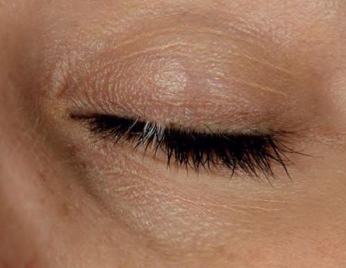 Как избавиться от пигментных пятен на лице. Пигментное пятно —, что это такое 11 Как избавиться от пигментных пятен на лице. Пигментное пятно —, что это такое 11