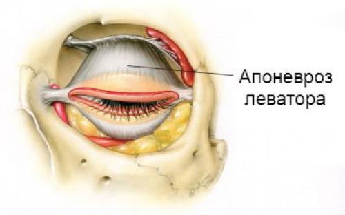 Как избавиться от птоза верхних век на лице. Причины развития патологического опущения верхнего века 04