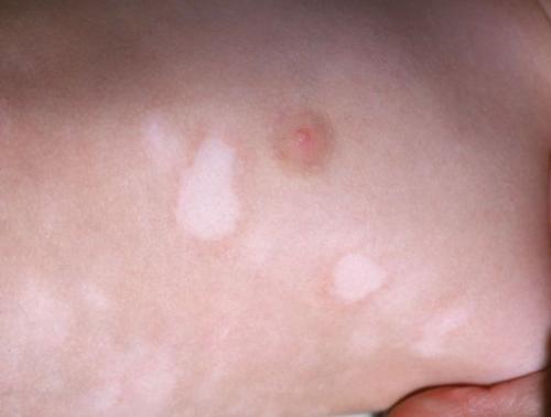 Как избавиться от пигментных пятен на лице. Пигментное пятно —, что это такое 12 Как избавиться от пигментных пятен на лице. Пигментное пятно —, что это такое 12