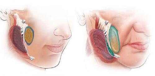 Гравитационный птоз нижней трети лица и верхнего века. Определение болезни. Причины заболевания 10 Гравитационный птоз нижней трети лица и верхнего века. Определение болезни. Причины заболевания 10