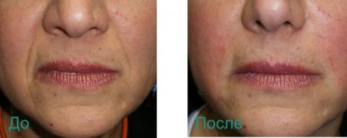 Как избавиться от носогубных складок в салоне. Удаление носогубных складок на лице