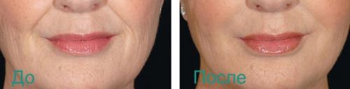 Как избавиться от носогубных складок в салоне. Удаление носогубных складок на лице